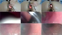 gape with speculum 2025-02-15 07_09.ScrinList gape with speculum 2025-02-15 07_09.ScrinList